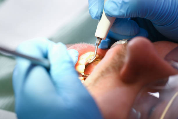 Best Knocked-Out Tooth Emergency  in Lanse, MI