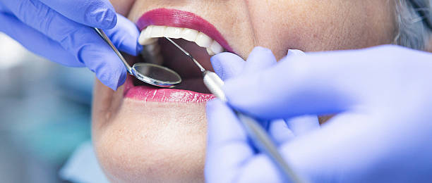Best Chipped Tooth Repair Near Me  in Lanse, MI